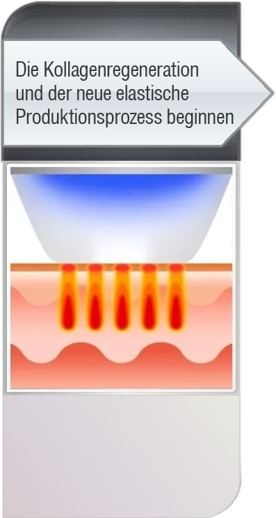 Kollagenregeneration und neu elastischer Produktionsprozess beginnt